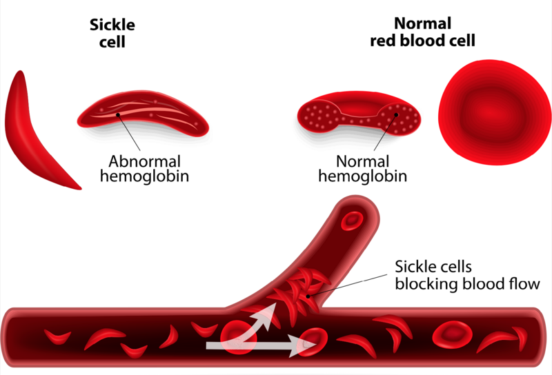 Sickle cell disease is an inherited blood disorder in which damaged hemoglobin can’t deliver oxygen to cells in the body. It afflicts millions of people worldwide.